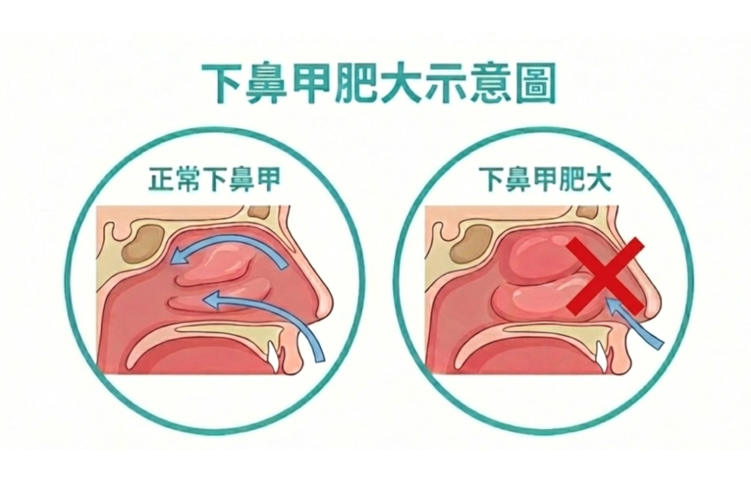 下鼻甲肥大怎麼辦_下鼻甲肥大為什麼會導致鼻塞